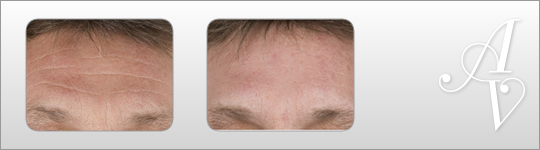 Botox treatments London | Botox Knightsbridge | London Botox treatments