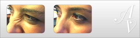 Before and After