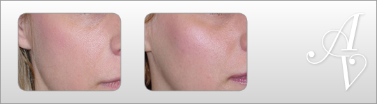 Before and After
