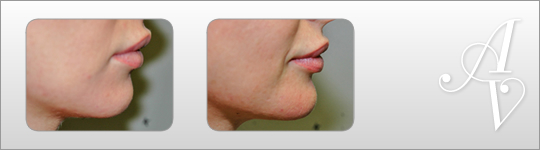 Dermal filler London | Dermal filler London | Dermal filler London | Dermal filler London