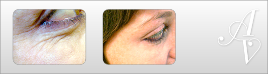 Wrinkle reduction London | Botox Harley Street London | Wrinkle reduction Harley Street London