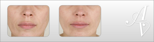Dermal filler Harley Street London | Skin tightening London | Dermal filler London
