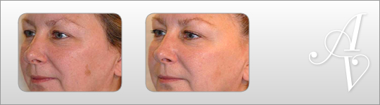Botox London | Cosmetic facial treatment London | Botox treatments London