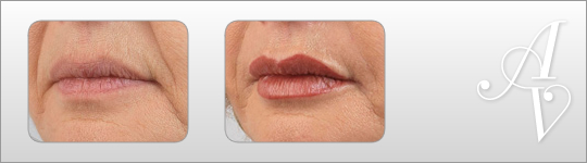 Lip fillers in London | Lip enhancement London | Lip enhancement Harley Street London