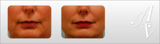 Before and After