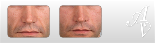 Before and After