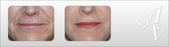 Wrinkle reduction London | Wrinkle reduction London | Wrinkle reduction London | Wrinkle reduction London | Wrinkle reduction London | Wrinkle reduction London