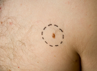 Mole removal Harley Street London | Mole removal London